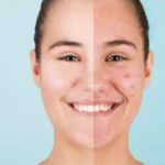 How to Get Rid of Acne Naturally: Effective Home Remedies