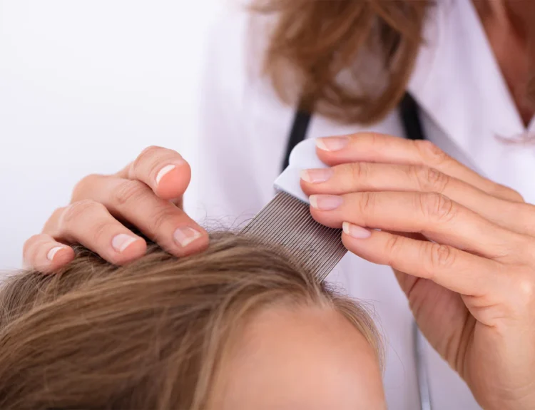 Effective Home Remedies for Lice Removal