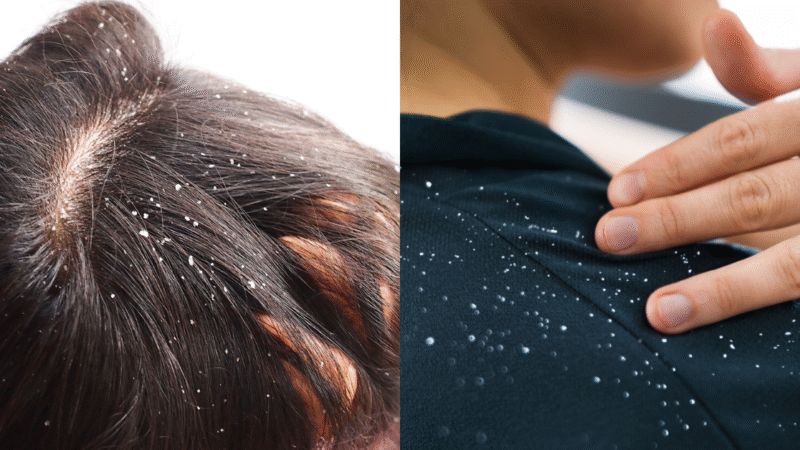 15 Effective Home Remedies to Cure Dandruff Naturally – Tried & Tested Solutions