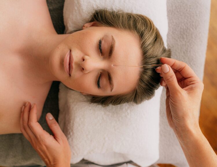 How Acupuncture Helps Relieve Stress – Natural Treatment Guide