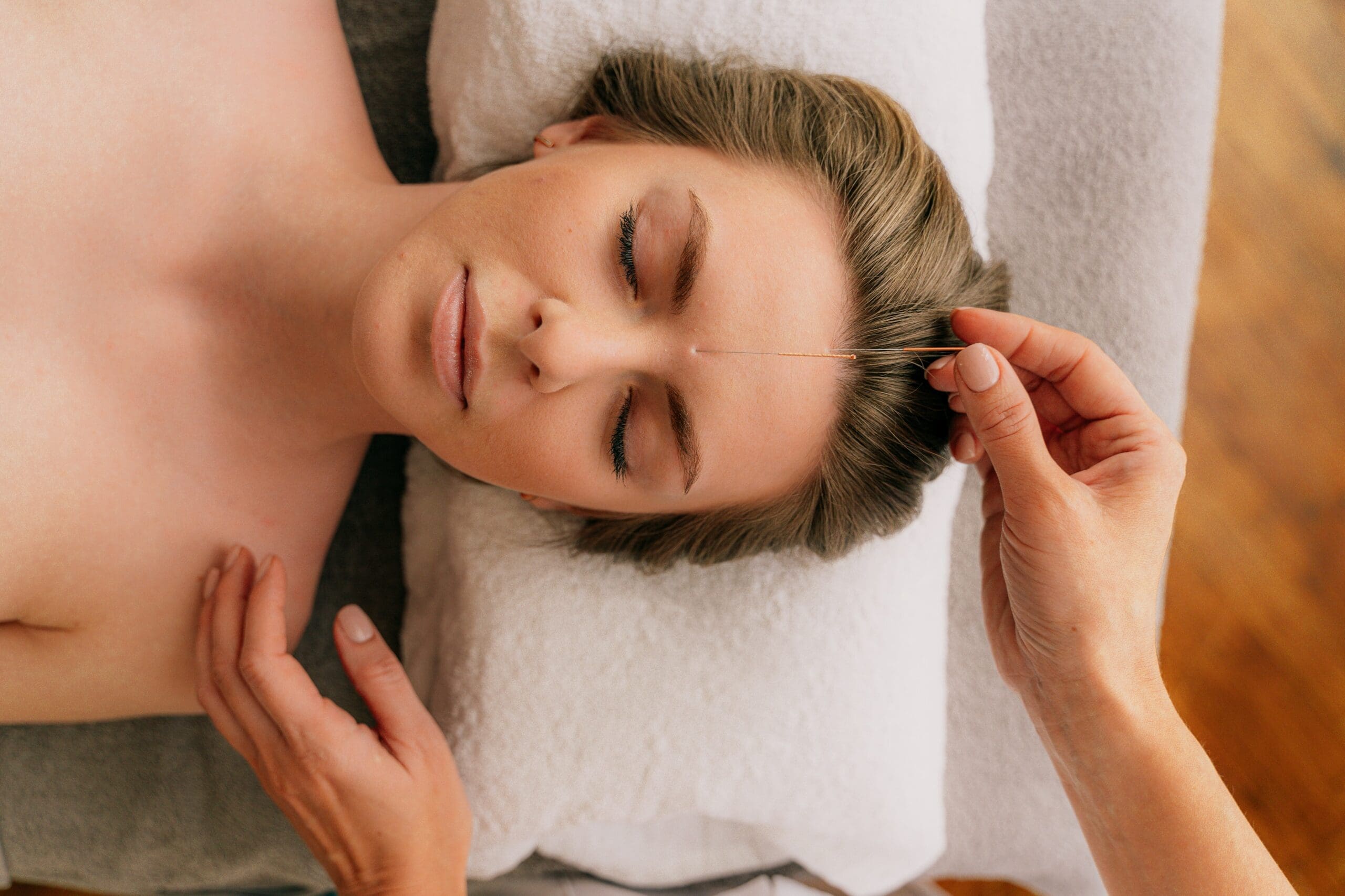 How Acupuncture Helps Relieve Stress – Natural Treatment Guide