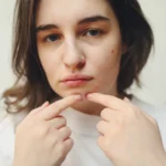 Understanding Acne: More Than Just a Few Pimples